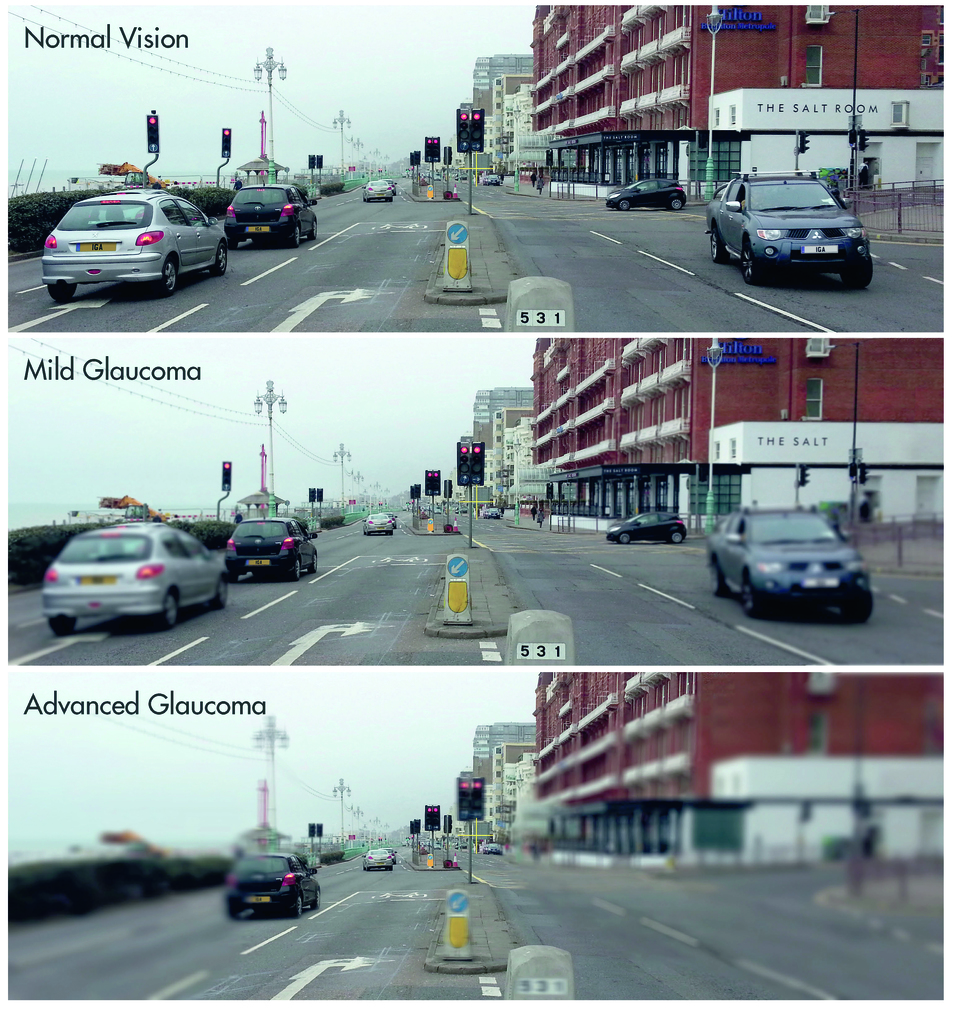 Specsavers Glaucoma driving